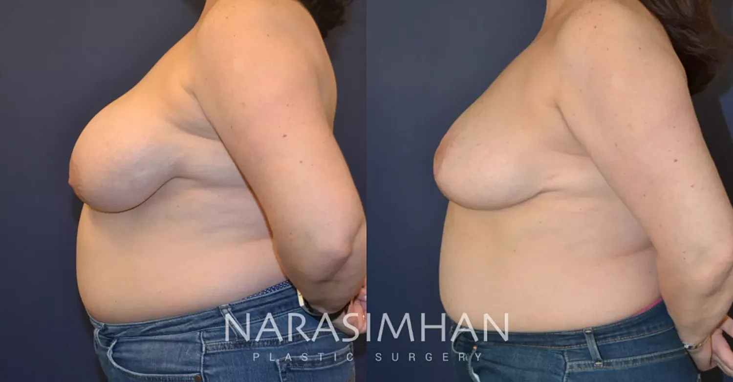 Breast Reduction Before & After