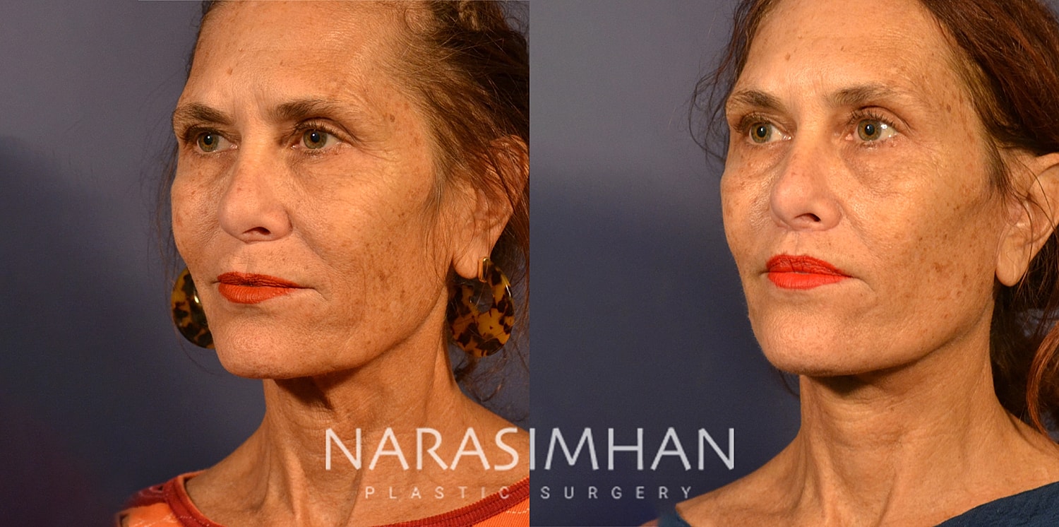 Lip Lift Before & After