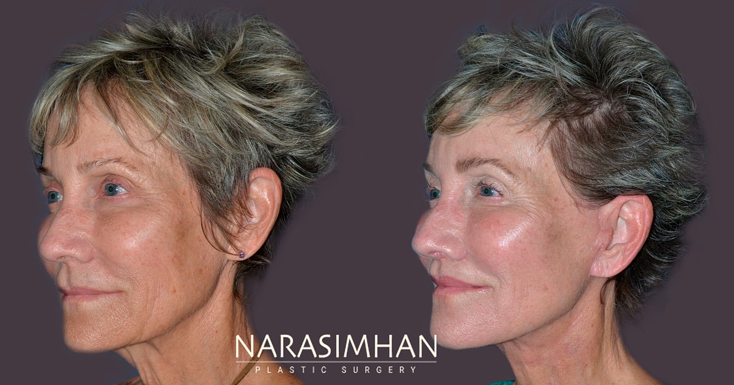 Lip Lift Before & After