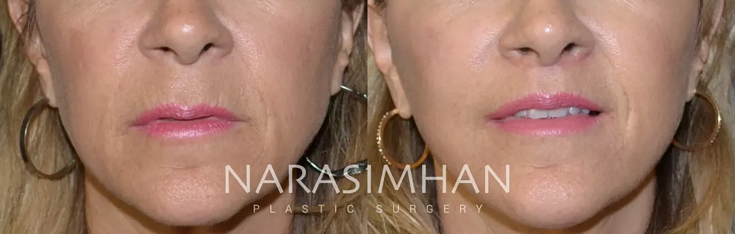 Lip Lift Before & After