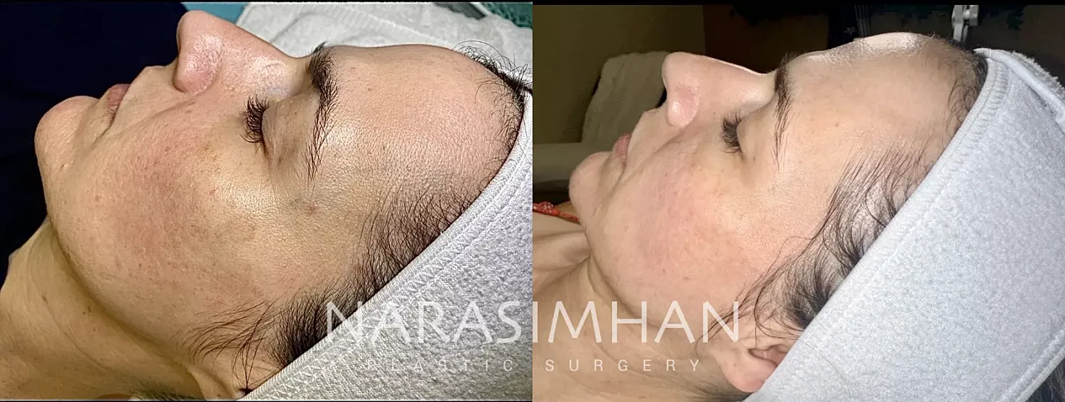 Sciton Laser Before & After