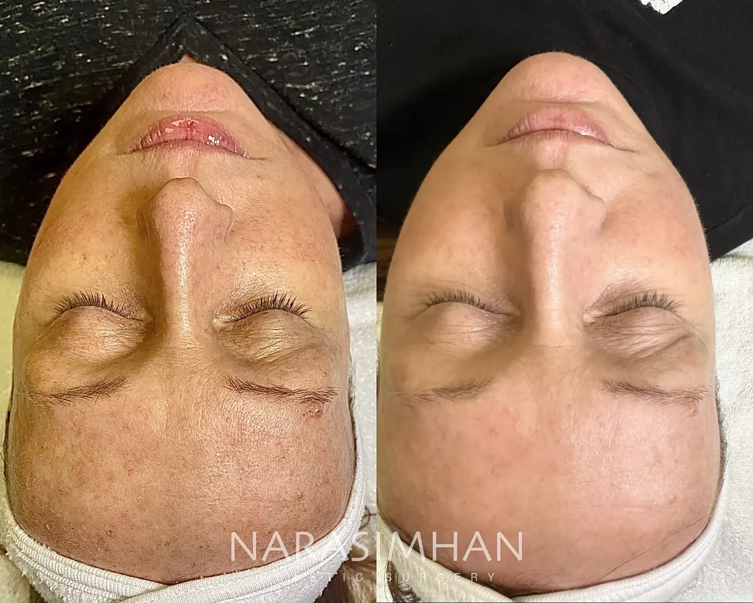 Sciton Laser Before & After