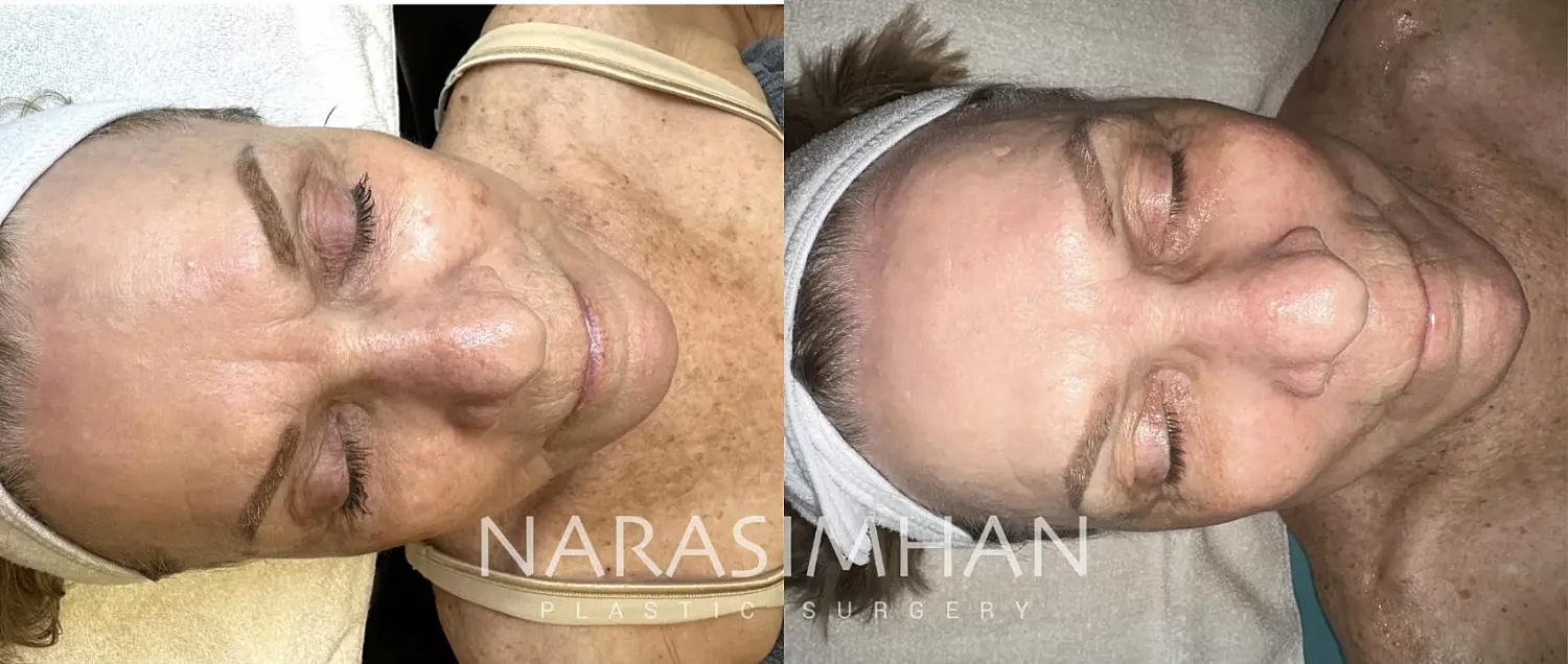 Sciton Laser Before & After