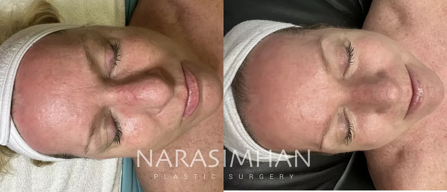 Sciton Laser Before & After