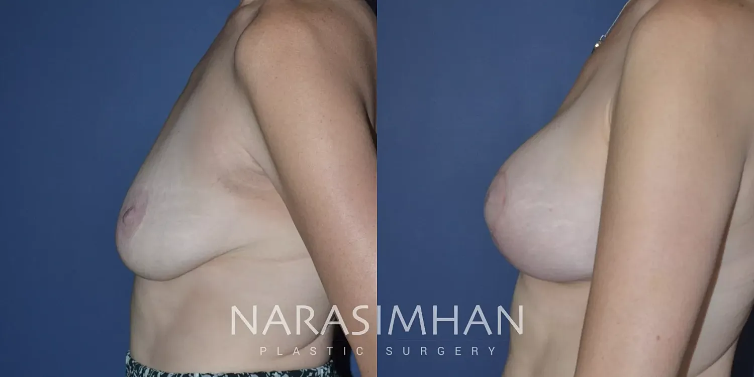 Mastopexy Before & After