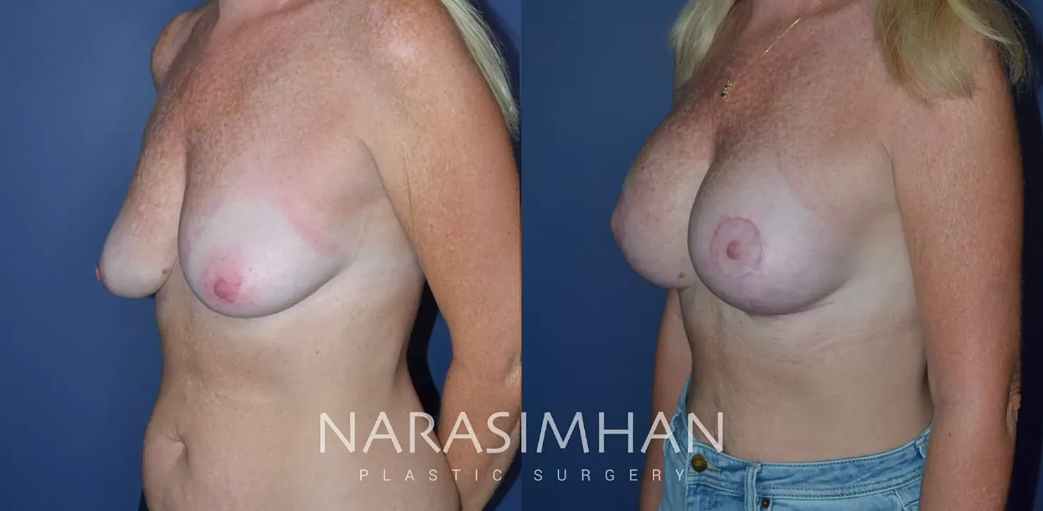 Mastopexy Before & After