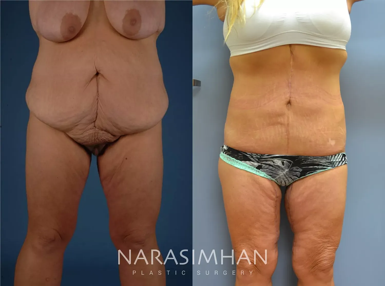 Tummy Tuck Before & After