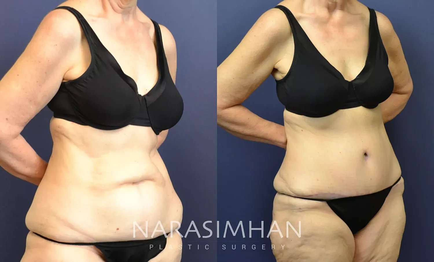 Tummy Tuck Before & After