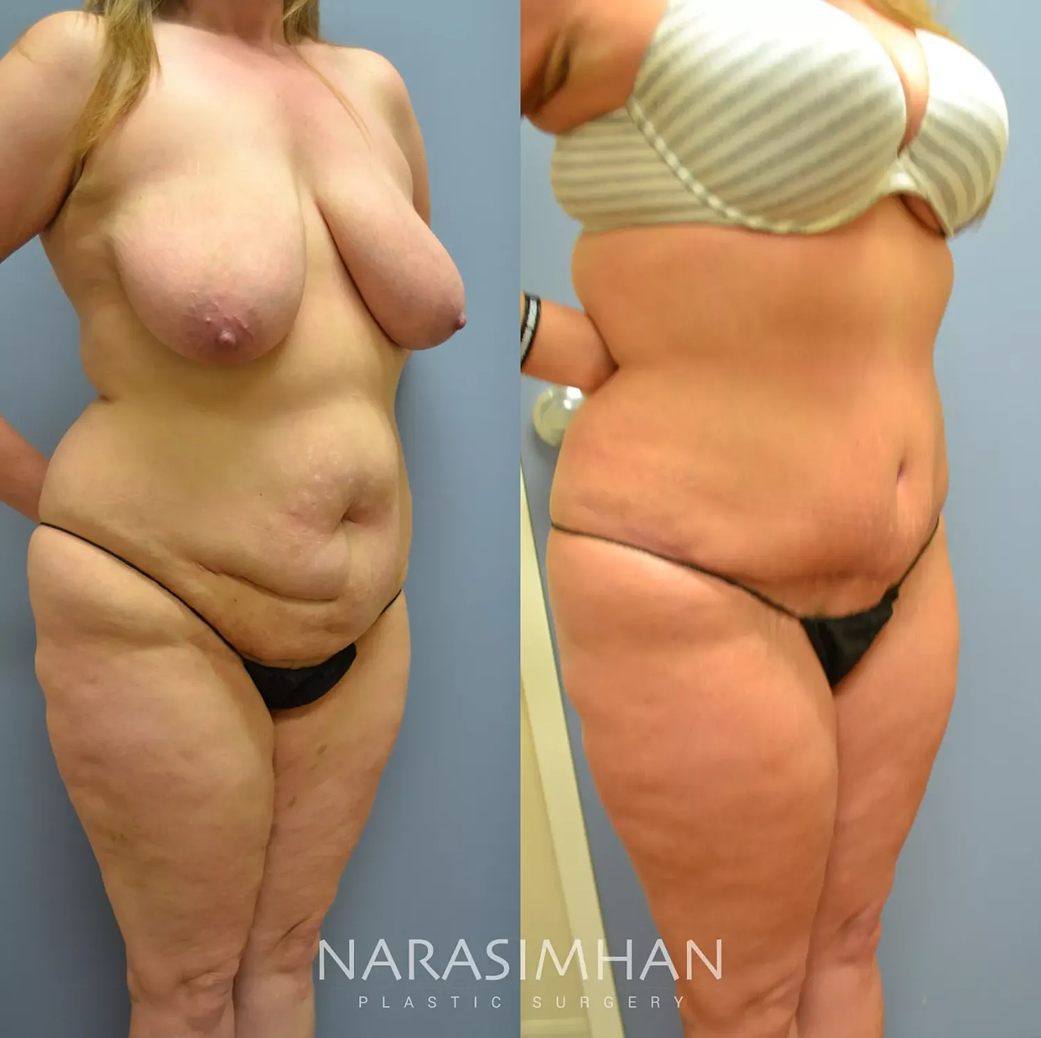 Tummy Tuck Before & After