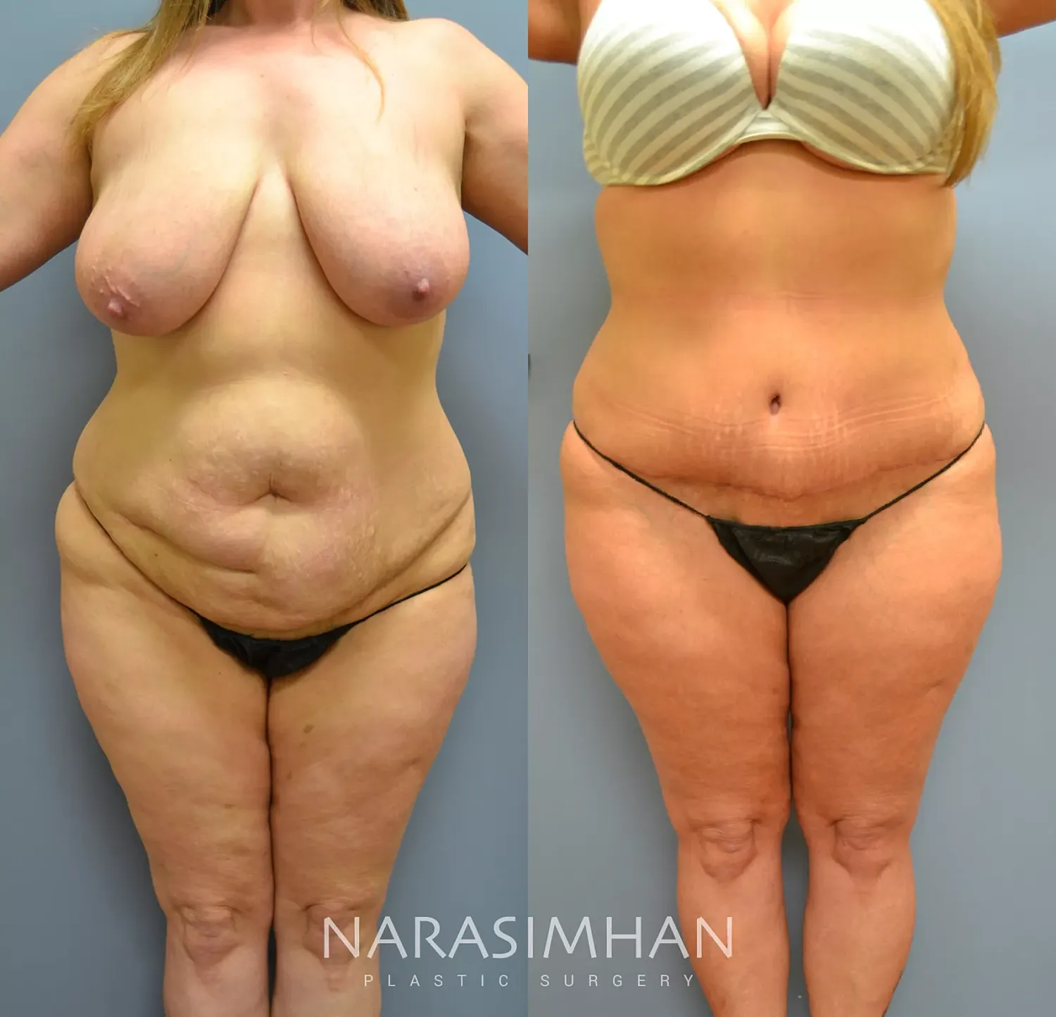 Tummy Tuck Before & After