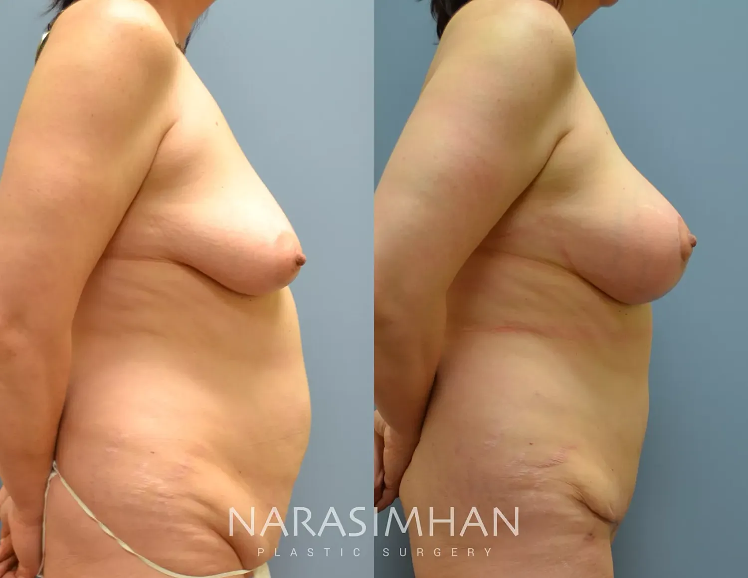 Tummy Tuck Before & After