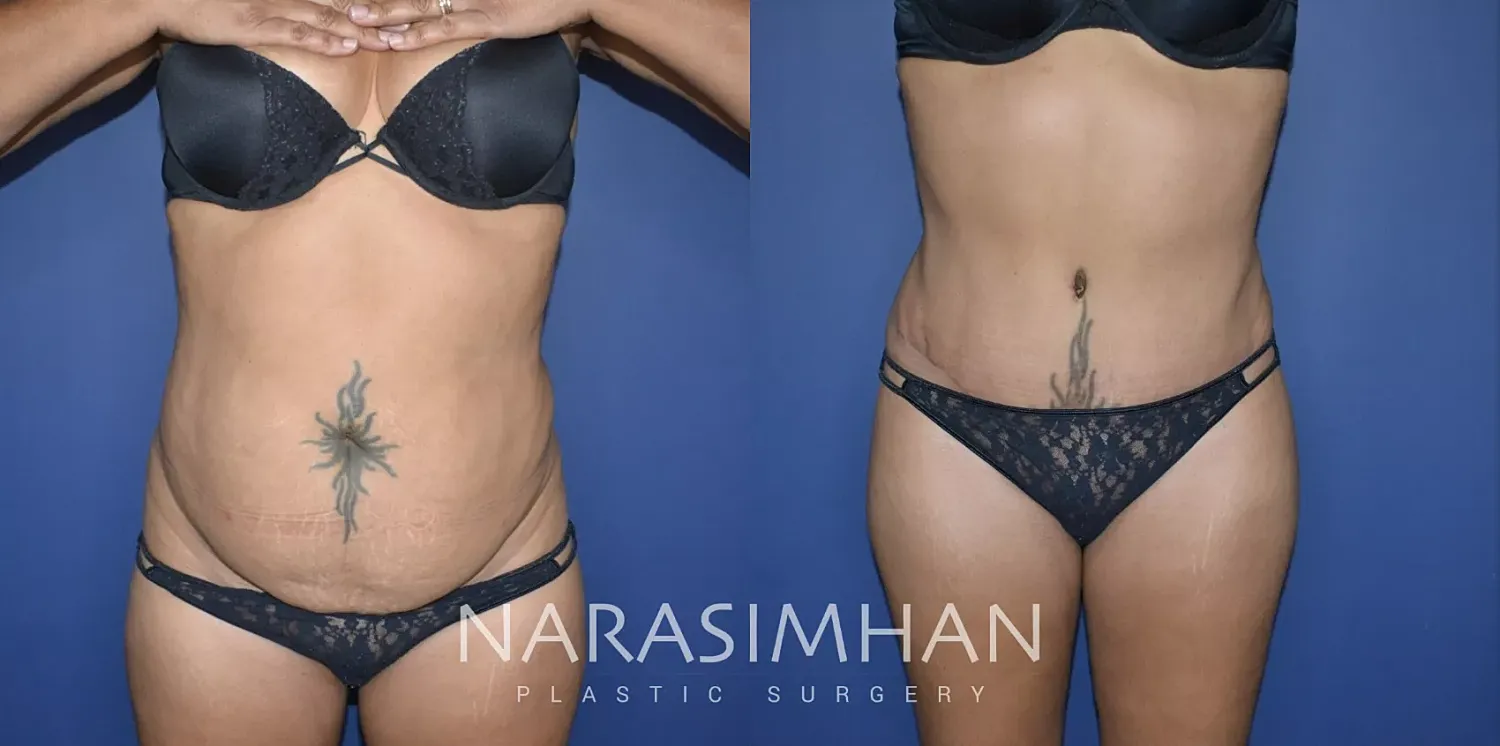 Tummy Tuck Before & After