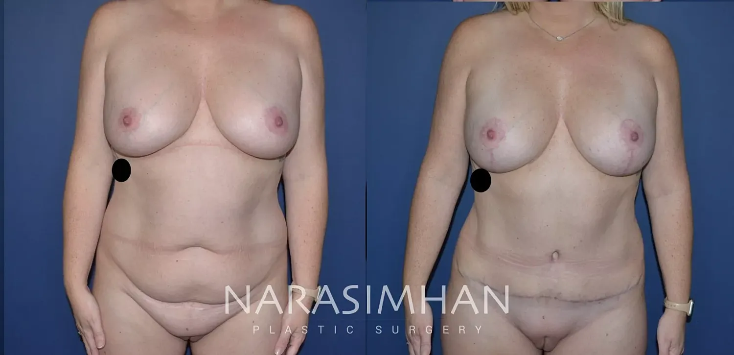 Tummy Tuck Before & After