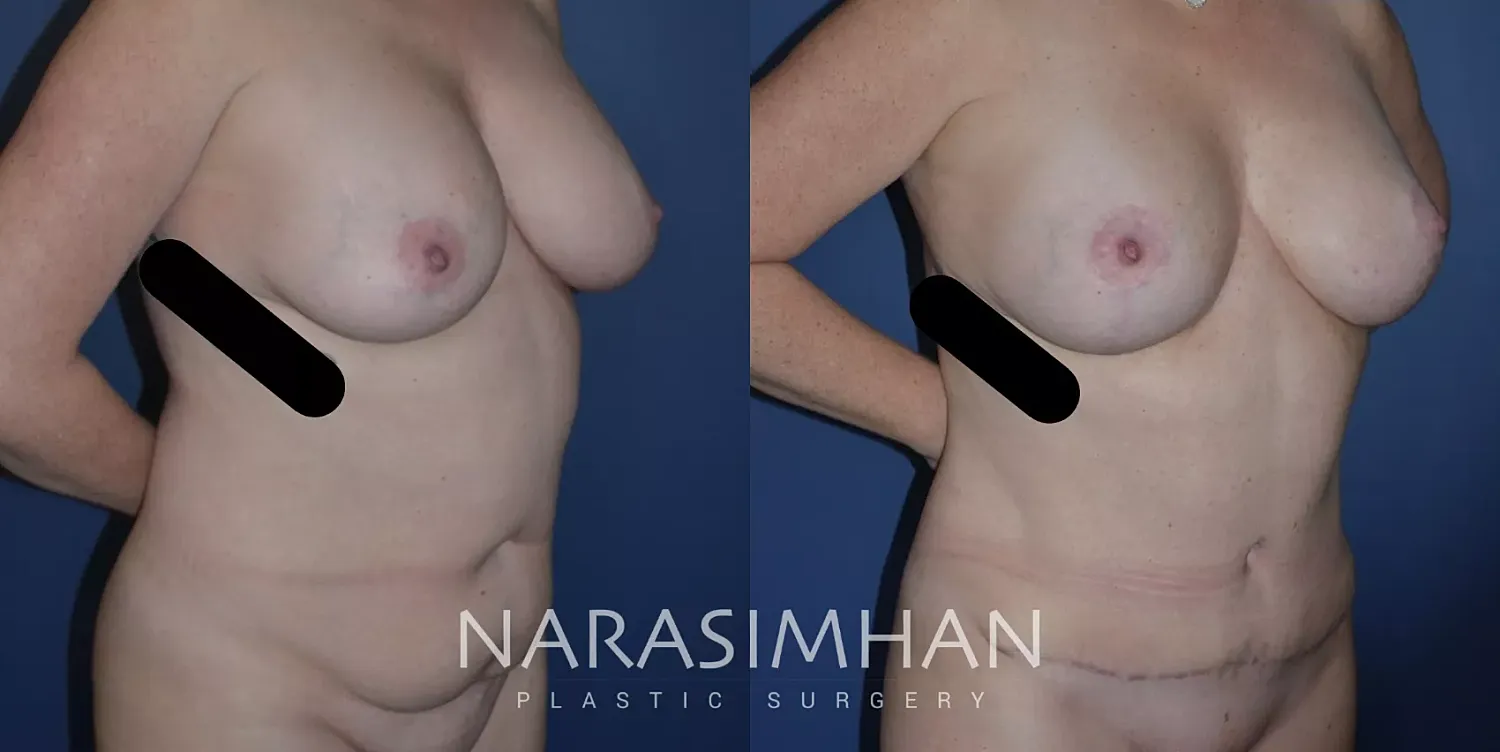 Tummy Tuck Before & After