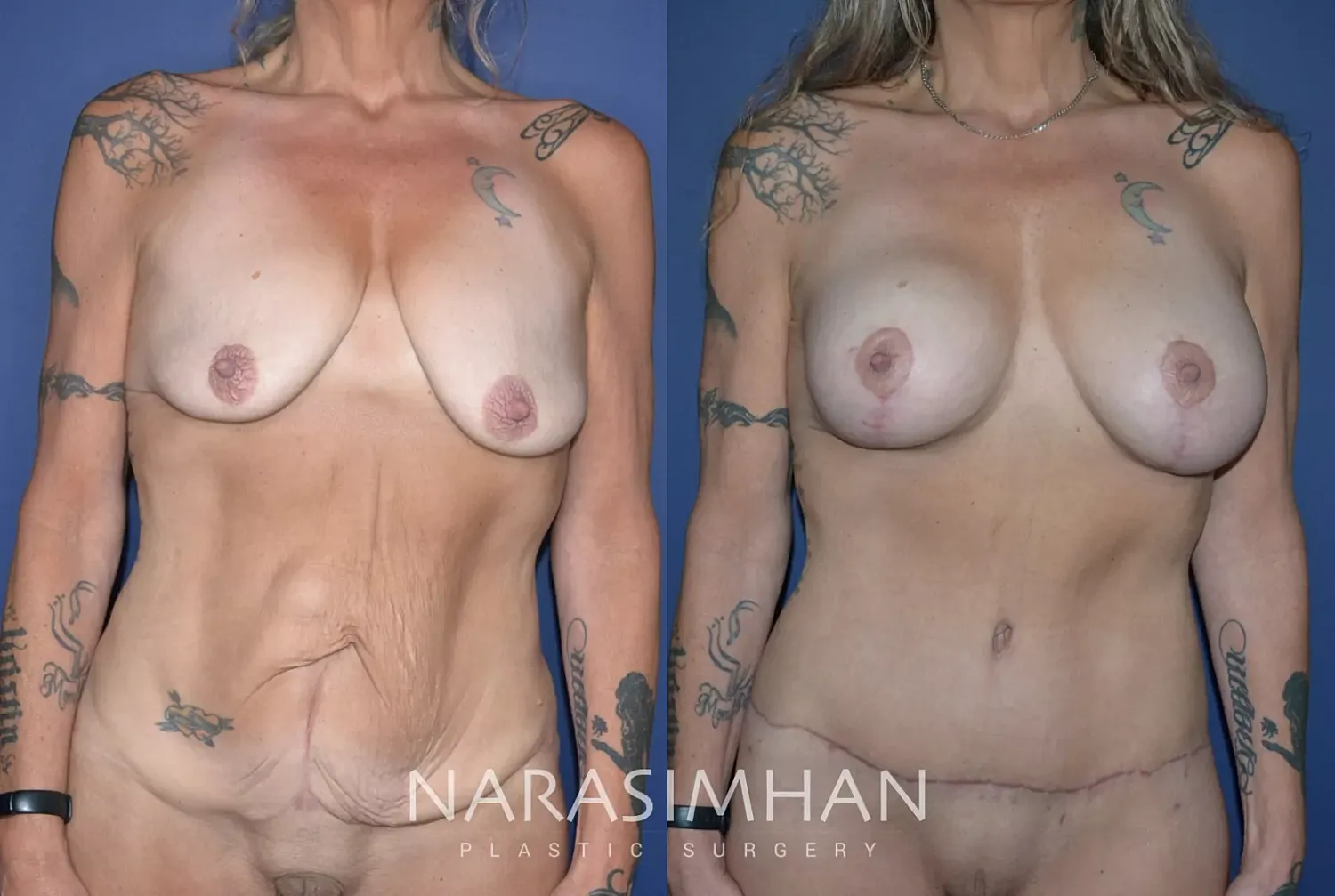 Tummy Tuck Before & After