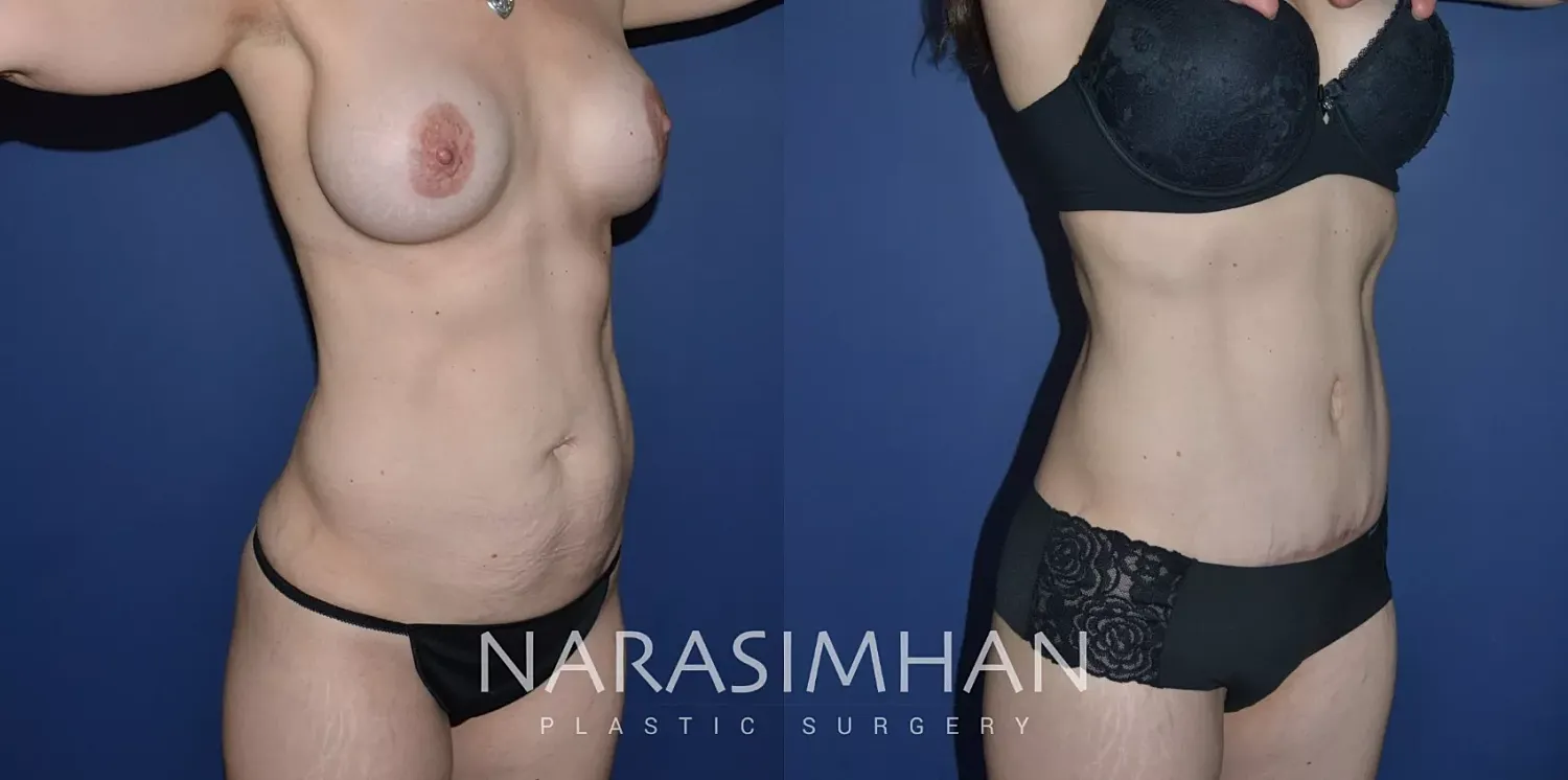 Tummy Tuck Before & After