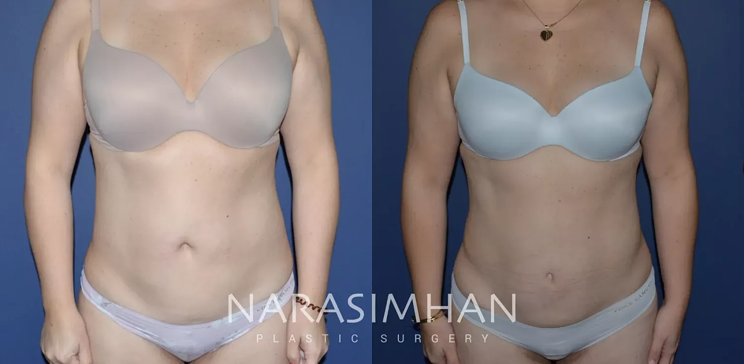 Tummy Tuck Before & After