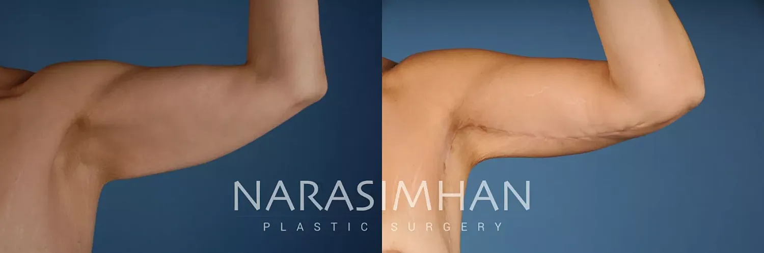 Tummy Tuck Before & After