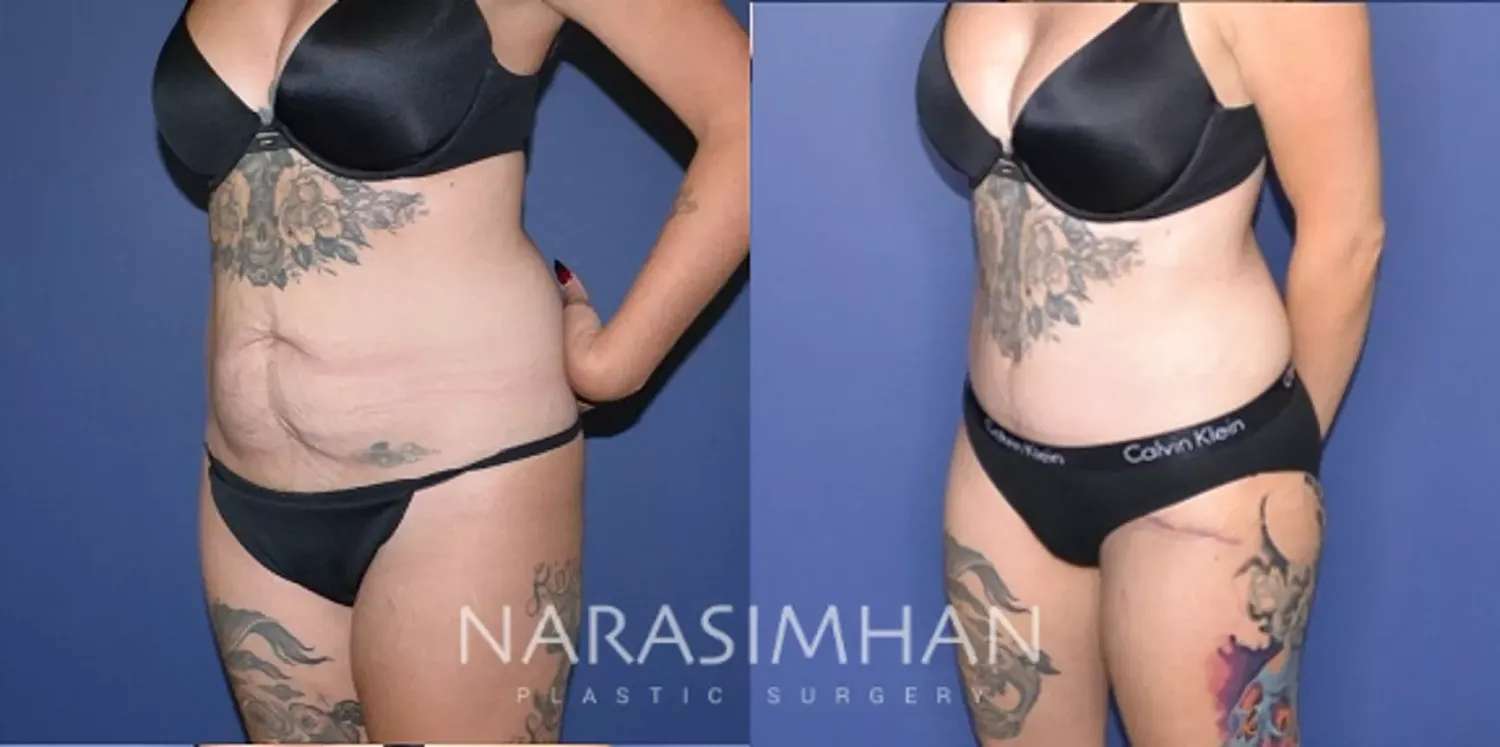 Tummy Tuck Before & After