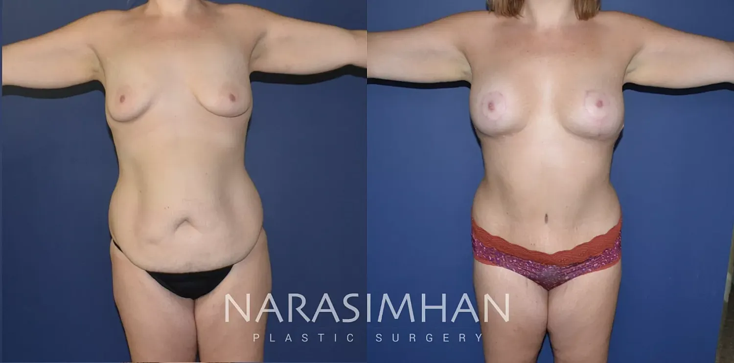 Tummy Tuck Before & After