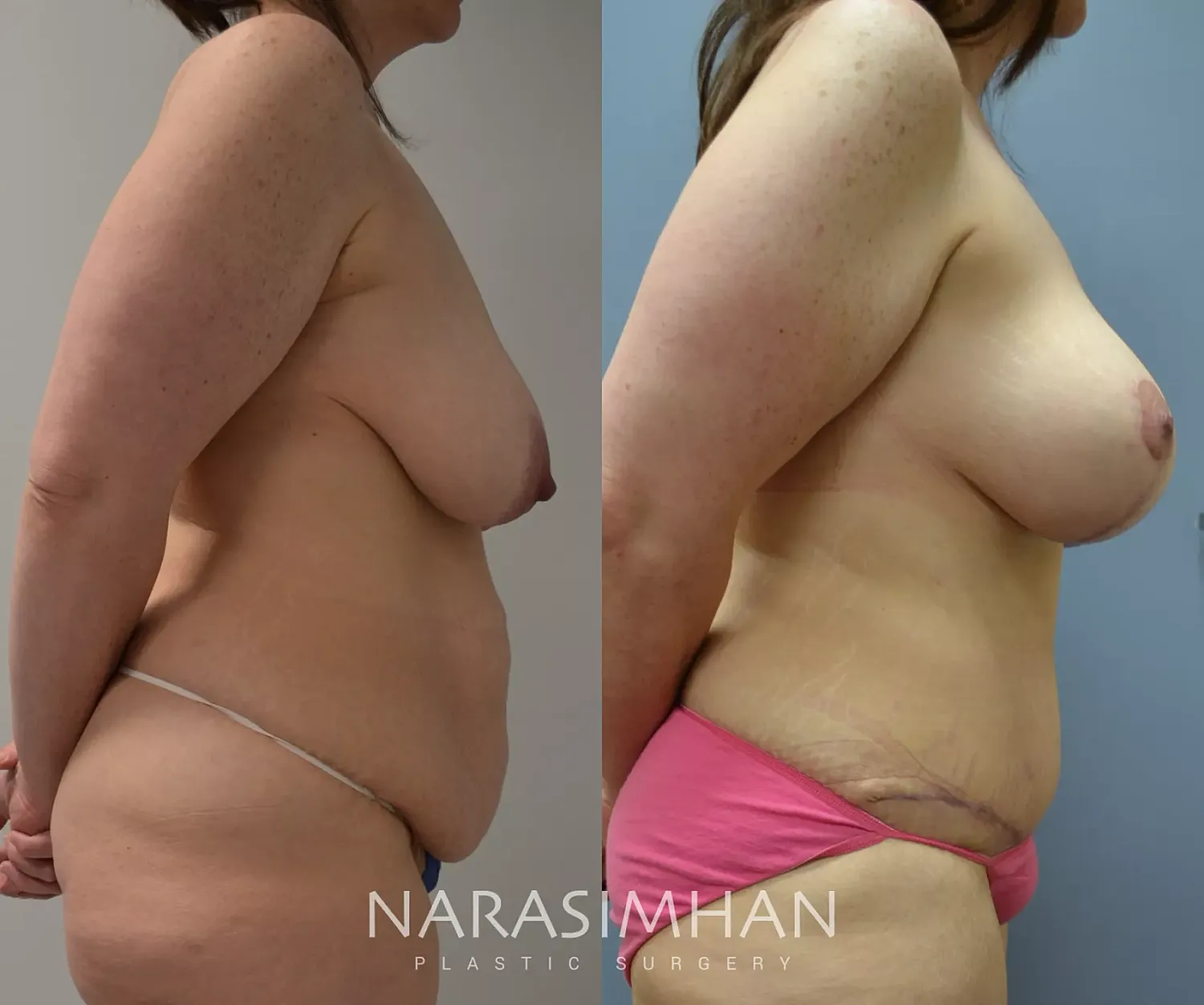 Tummy Tuck Before & After