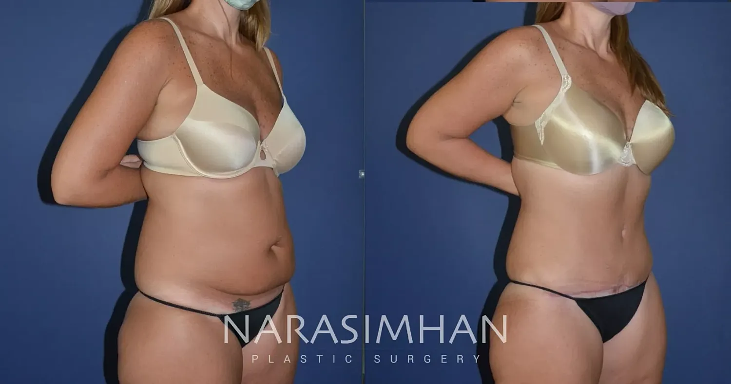 Tummy Tuck Before & After
