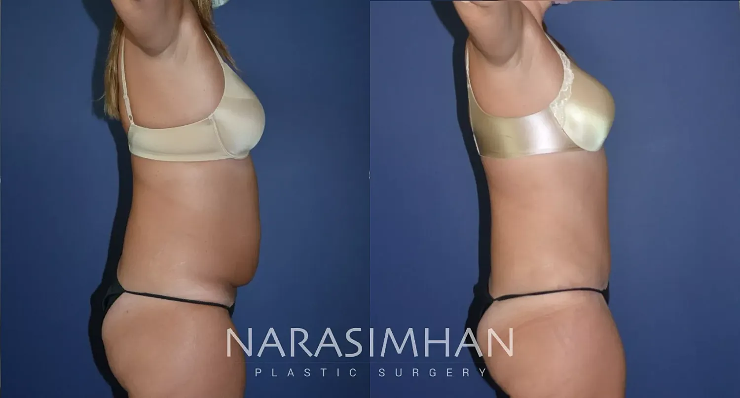 Tummy Tuck Before & After