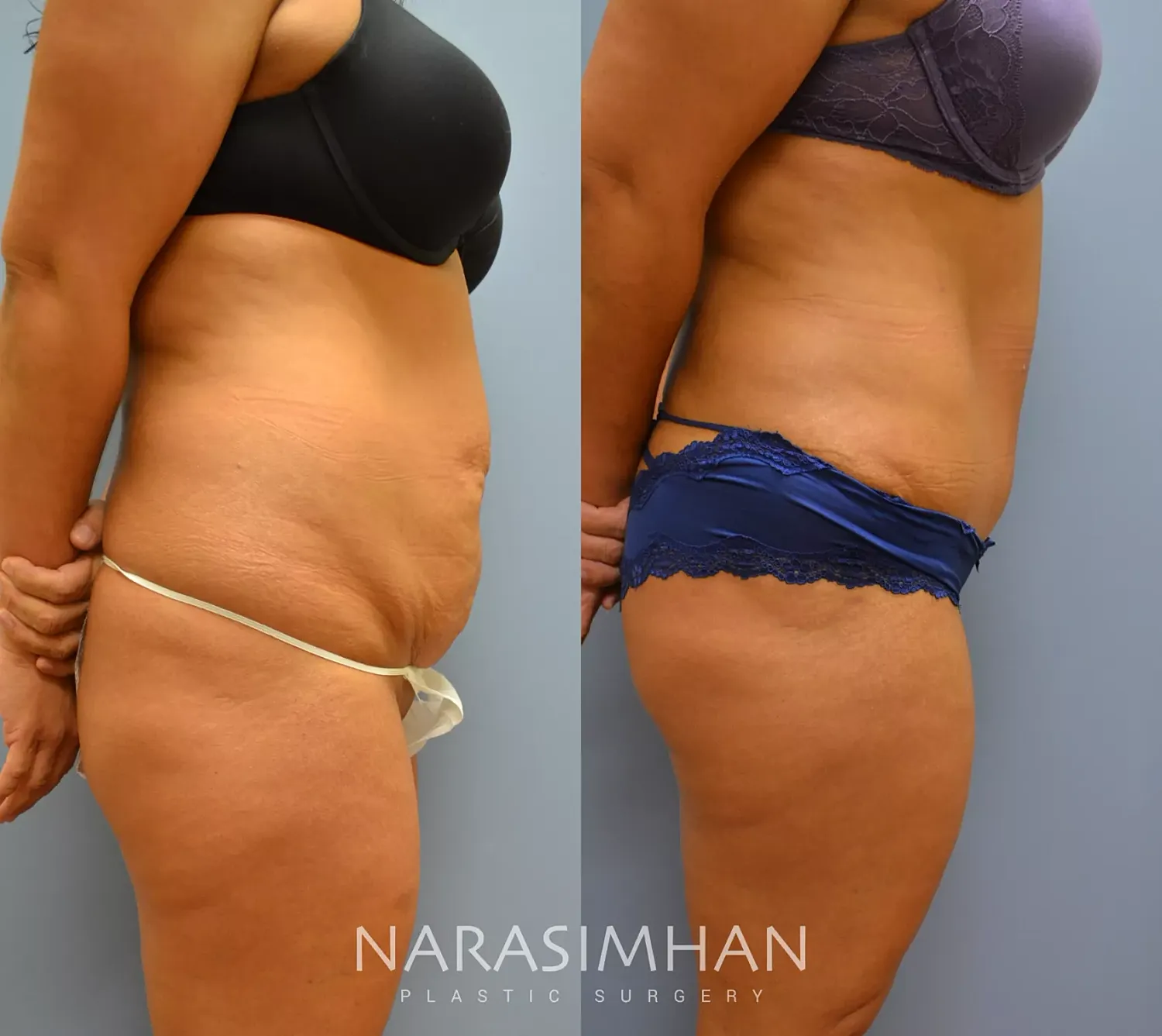 Tummy Tuck Before & After