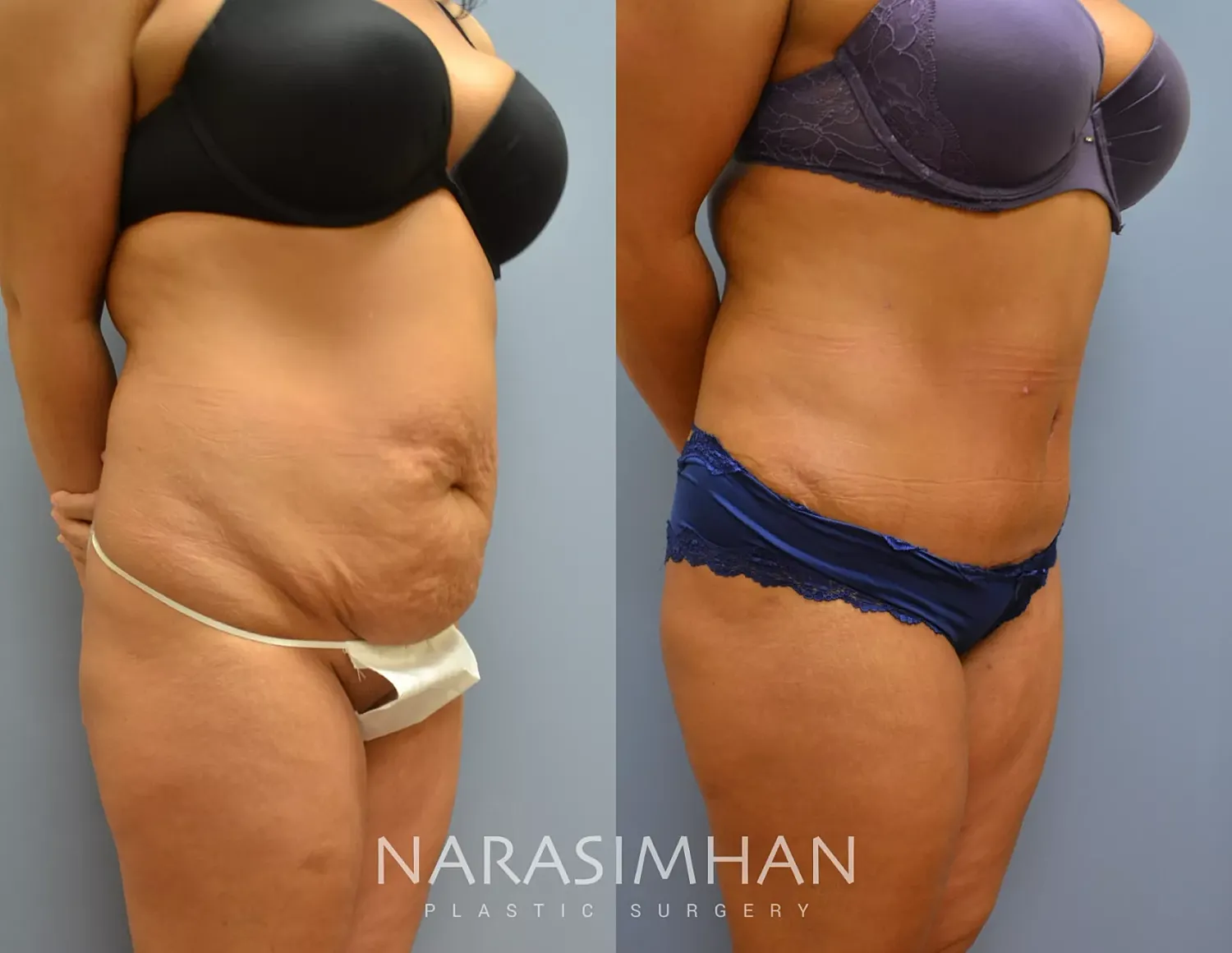 Tummy Tuck Before & After