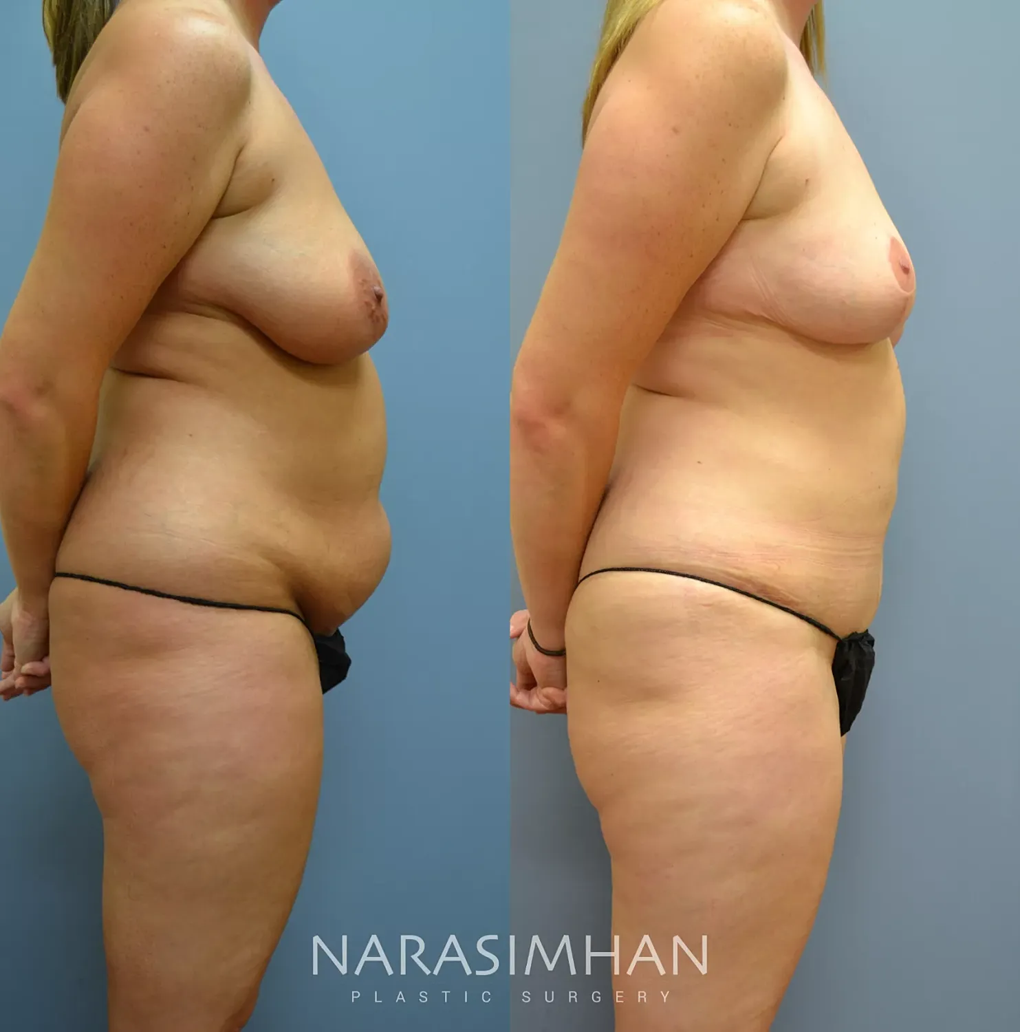 Tummy Tuck Before & After