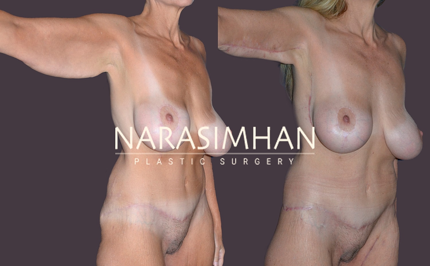 Post Weight Loss Skin Tightening Before & After