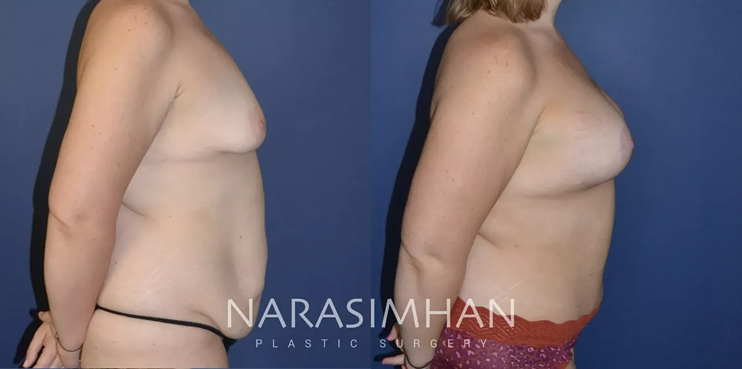 Post Weight Loss Skin Tightening Before & After