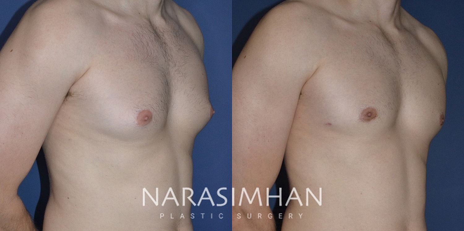 Gynecomastia Before & After