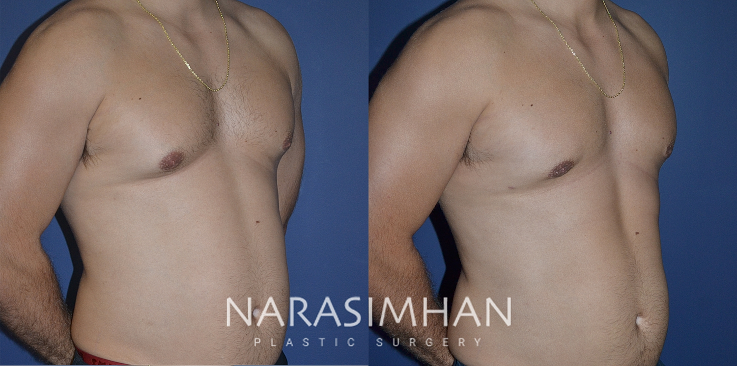 Gynecomastia Before & After