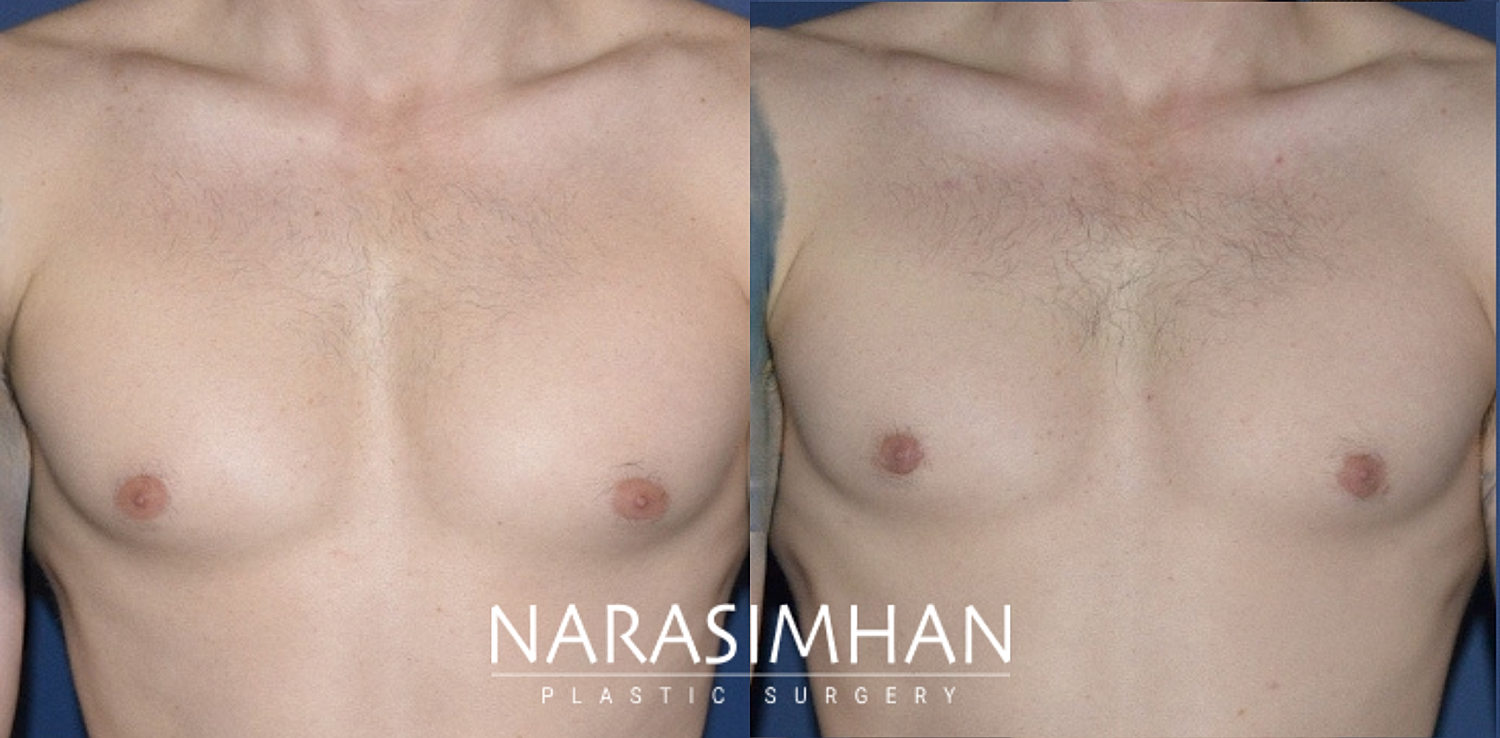 Gynecomastia Before & After