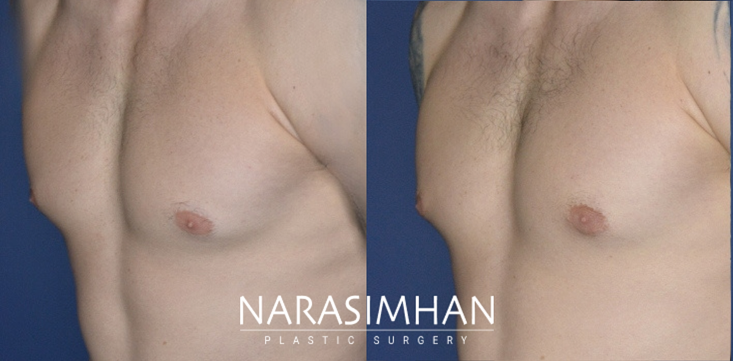 Gynecomastia Before & After