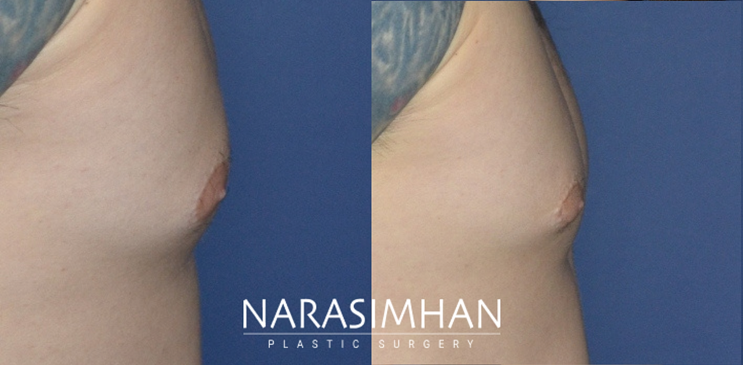 Gynecomastia Before & After