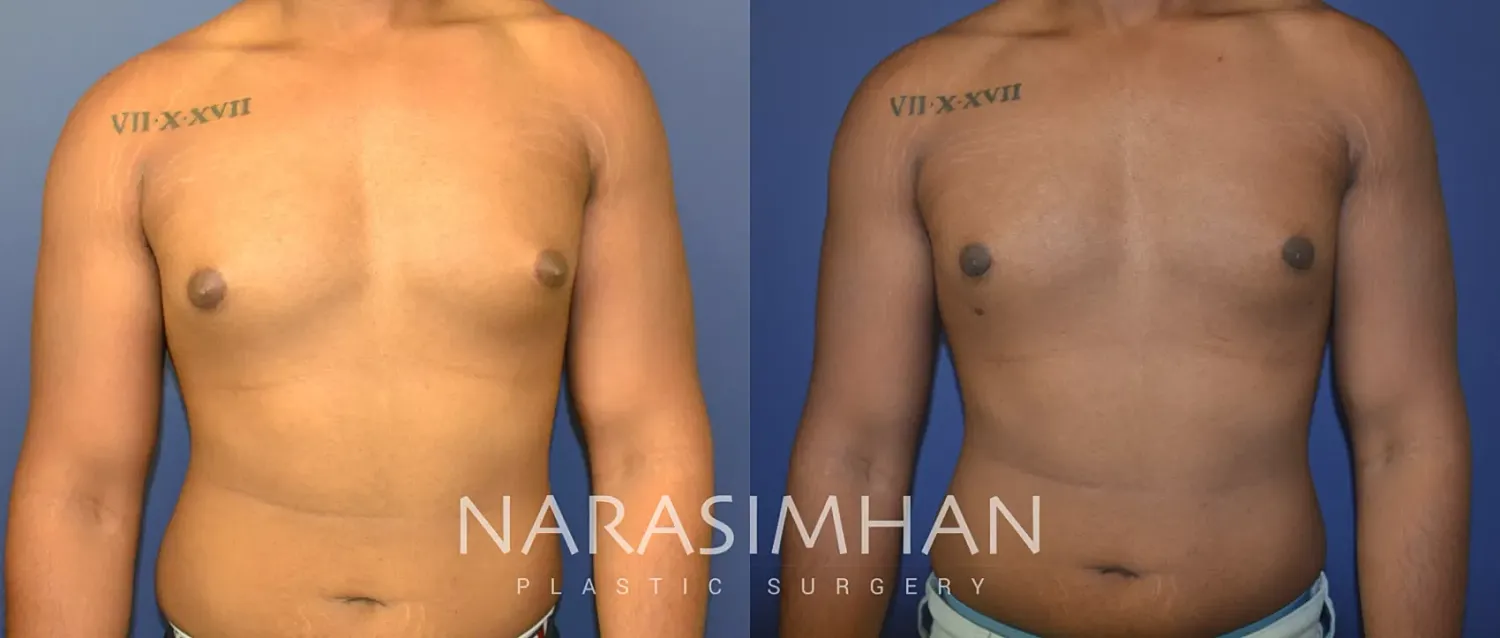 Gynecomastia Before & After