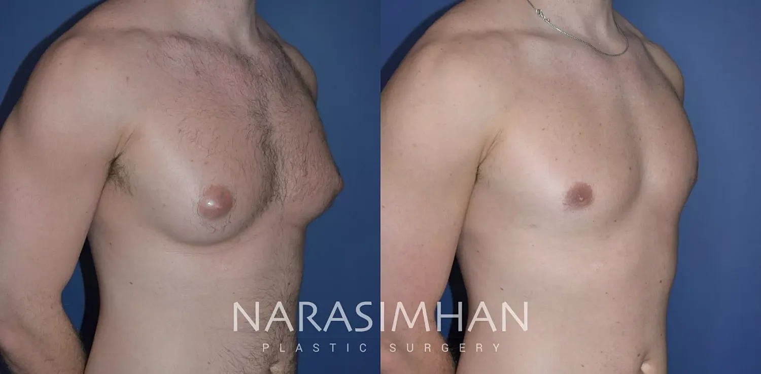 Gynecomastia Before & After