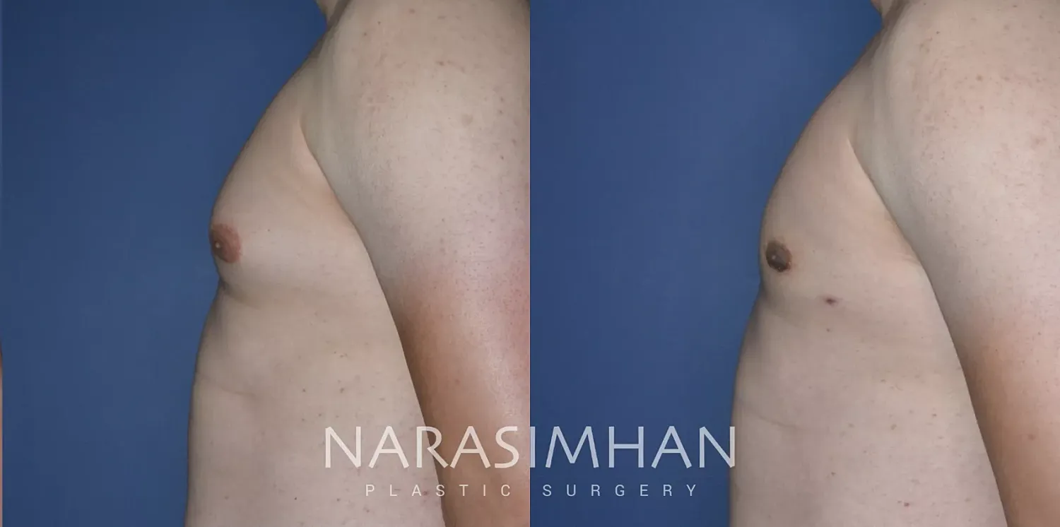 Gynecomastia Before & After