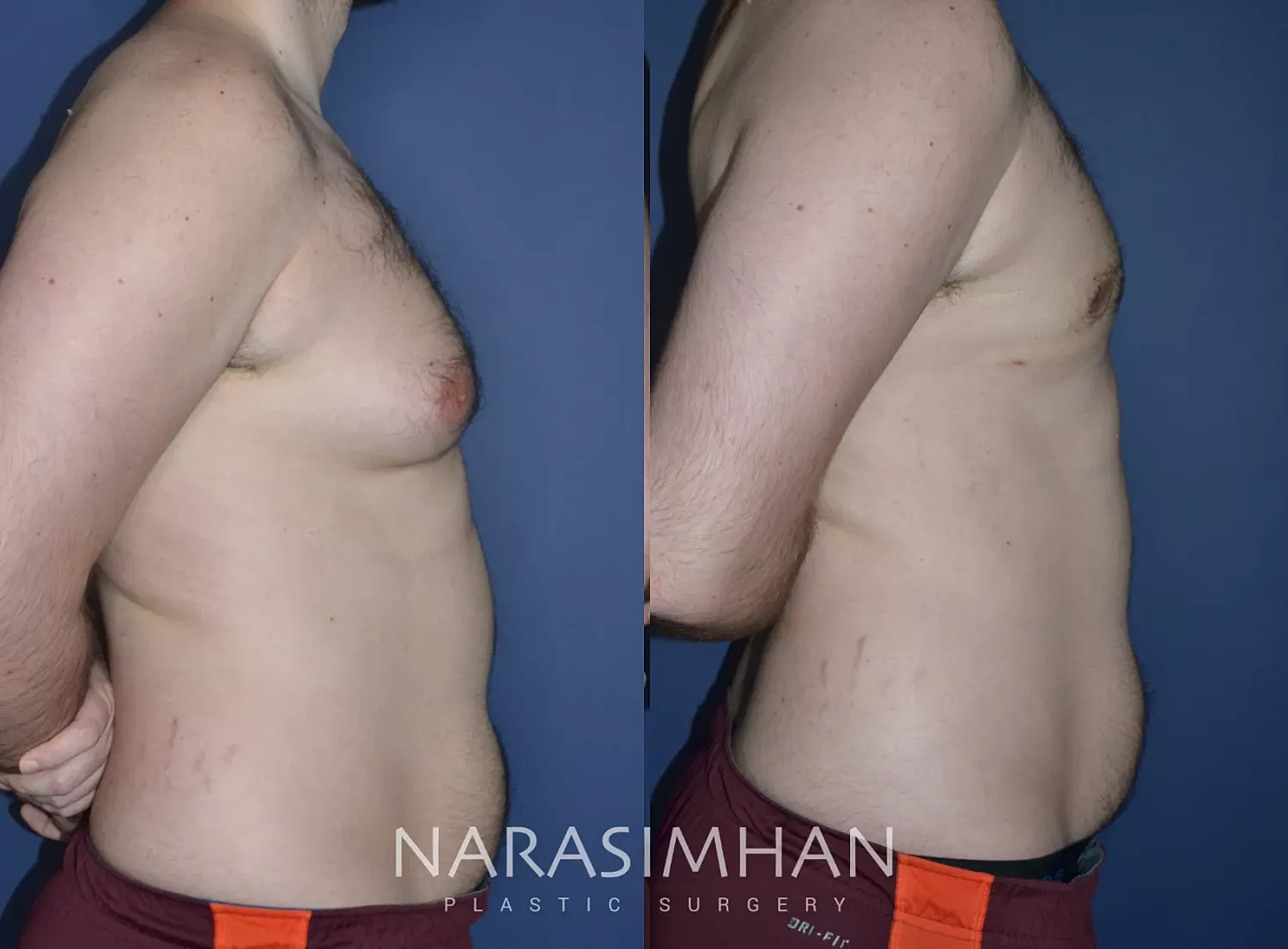 Gynecomastia Before & After