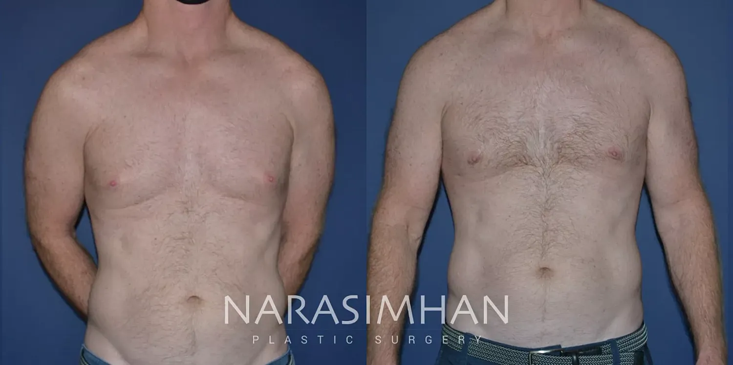 Gynecomastia Before & After