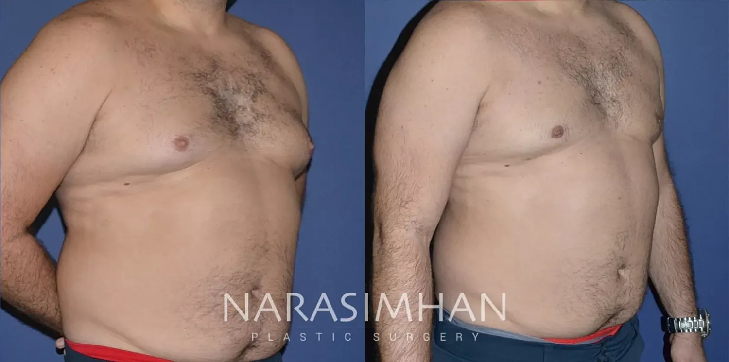 Gynecomastia Before & After