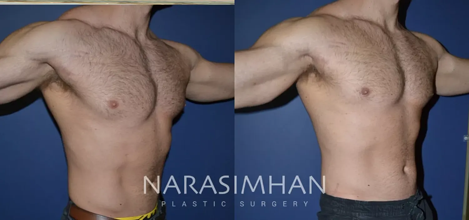 Gynecomastia Before & After