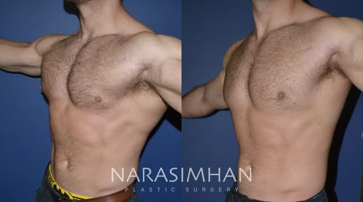 Gynecomastia Before & After