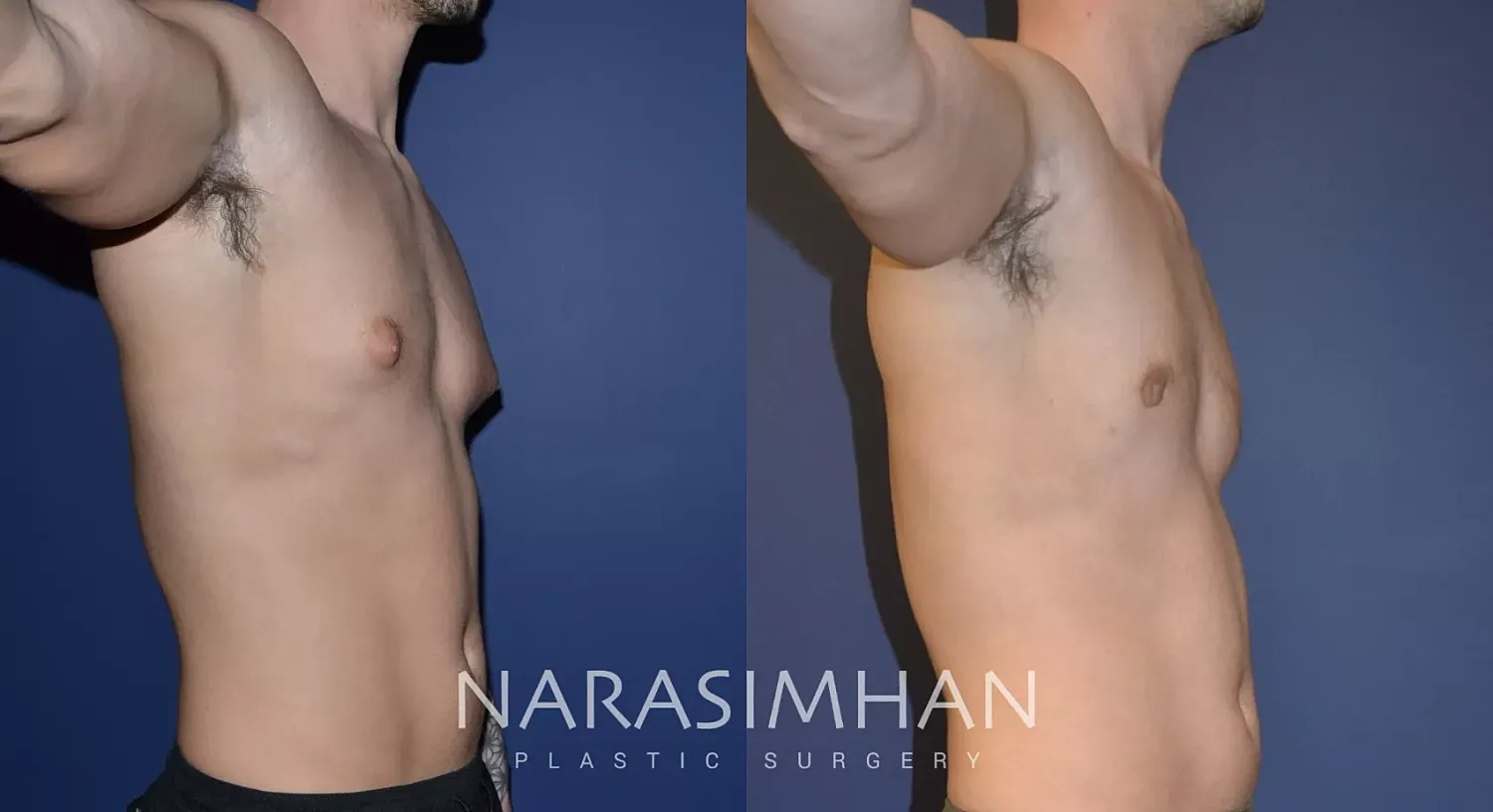 Gynecomastia Before & After