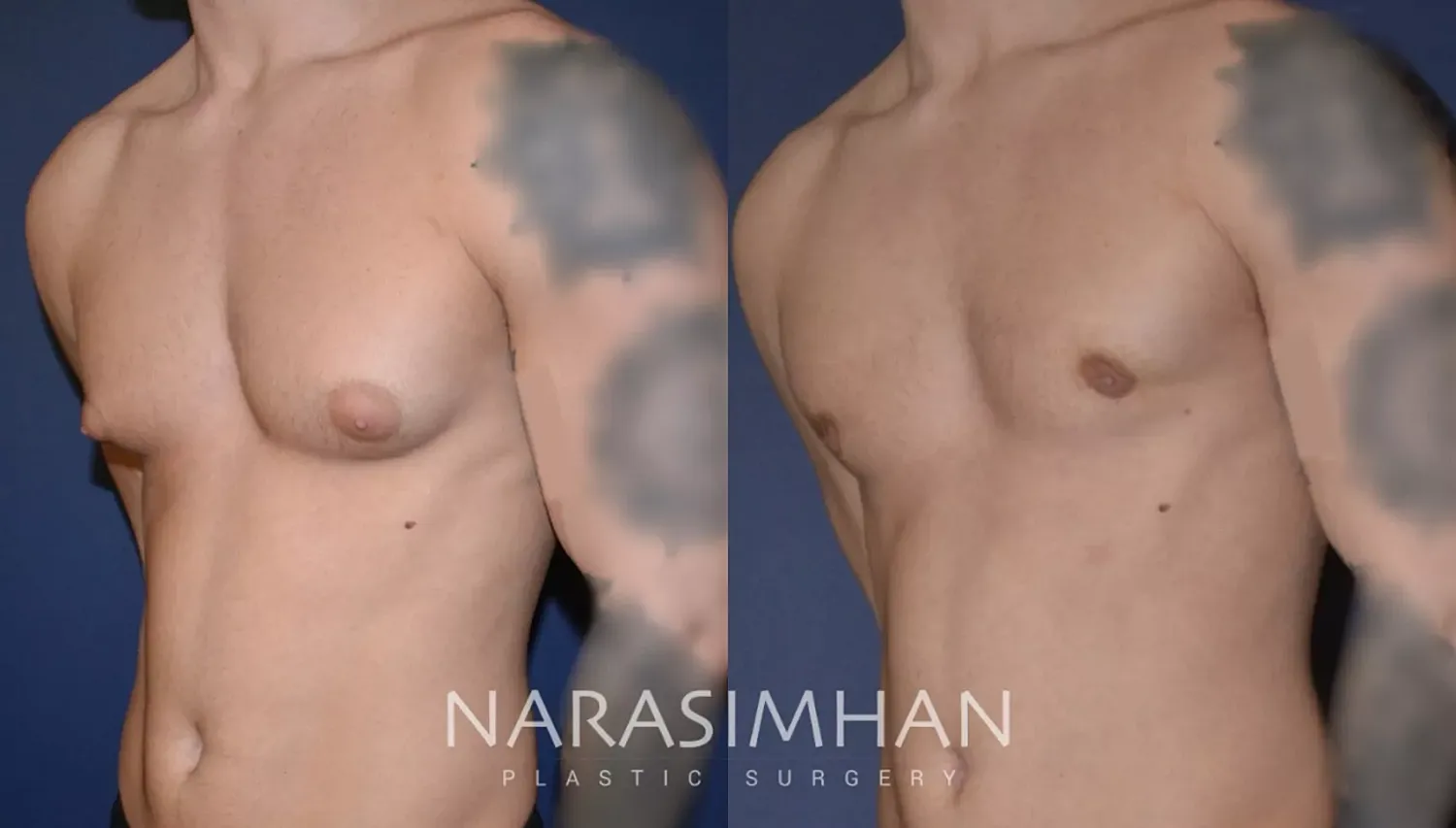 Gynecomastia Before & After
