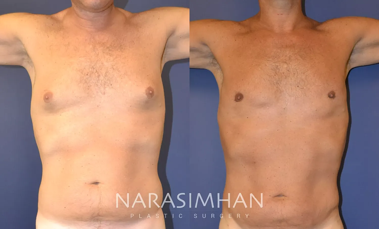 Gynecomastia Before & After