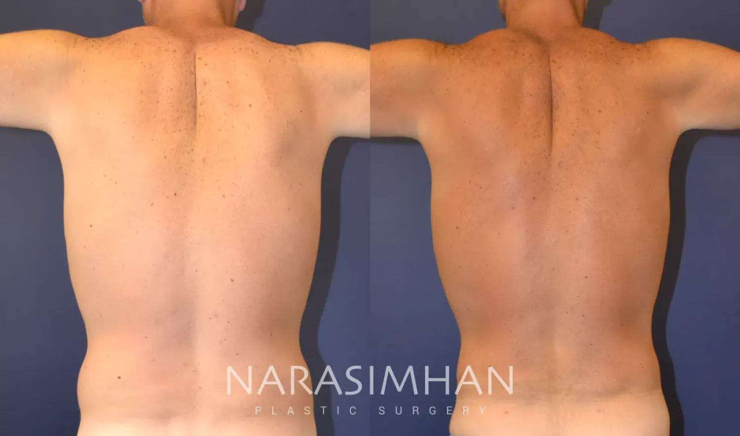Gynecomastia Before & After