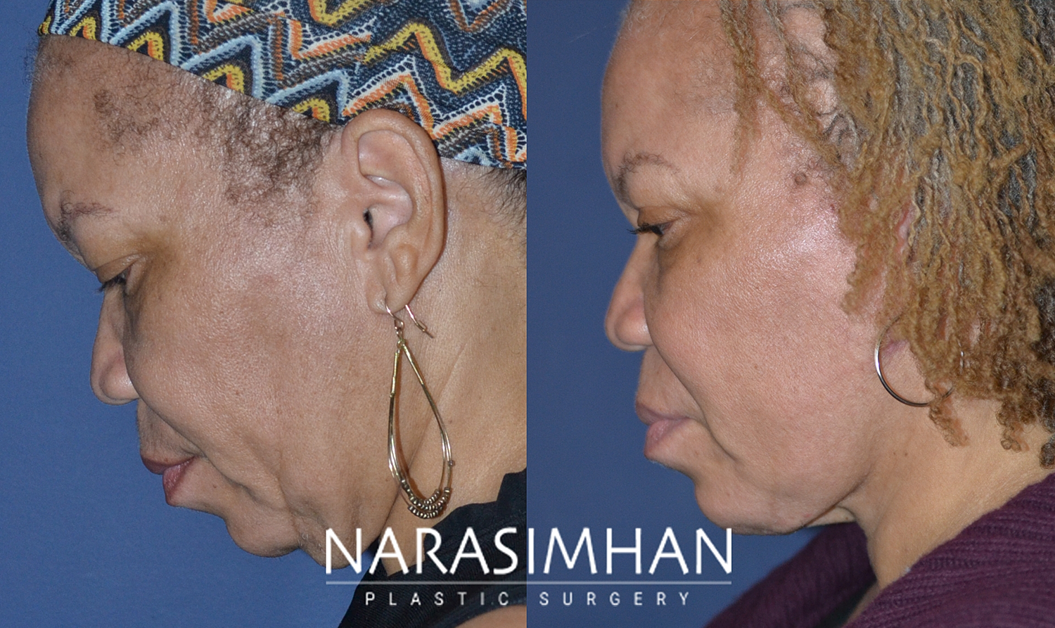 Blepharoplasty Before & After